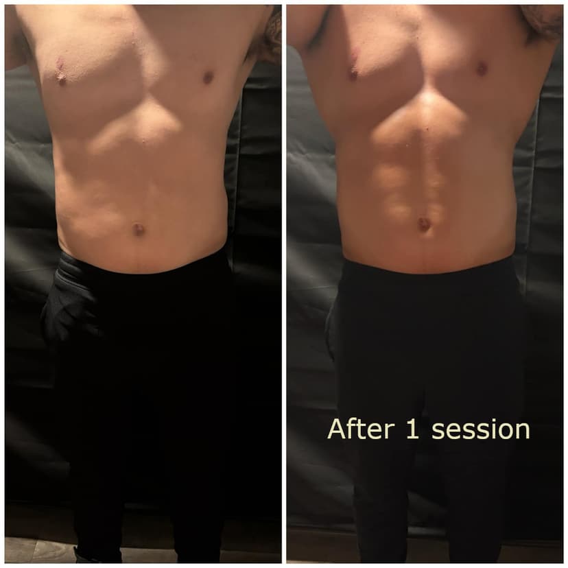 Ultrasonic Body Cavitation Results Image 1